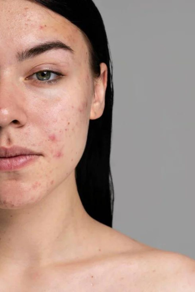 Acne Prone Skin