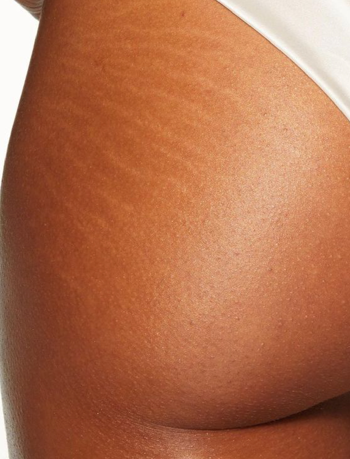 Stretch marks